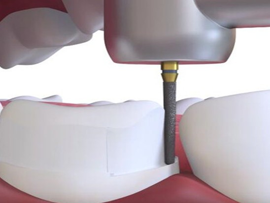 Dental Diamond Burs for Precision Drilling