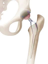 artificial joint